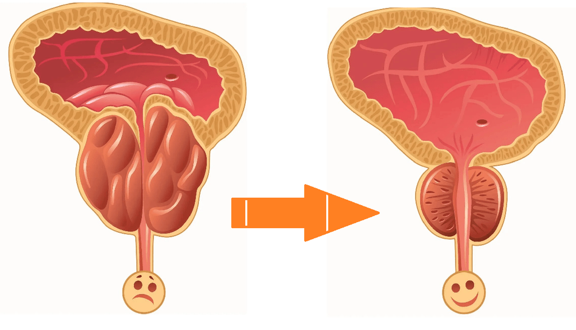 Efeito do Uromexil Forte na próstata com prostatite e adenoma