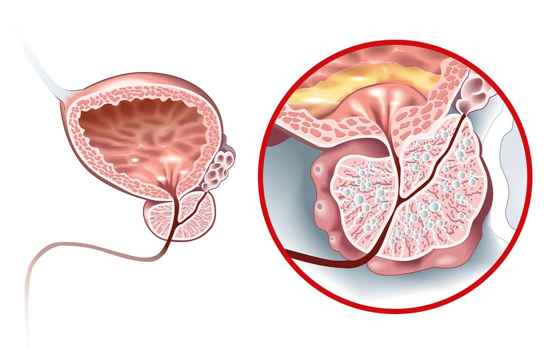 O que acontece com a próstata com adenoma e prostatite